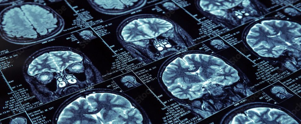 Alzheimer’s in China: The Largest Patient Pool in the World